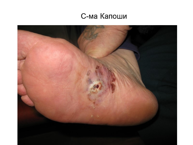 С-ма Капоши